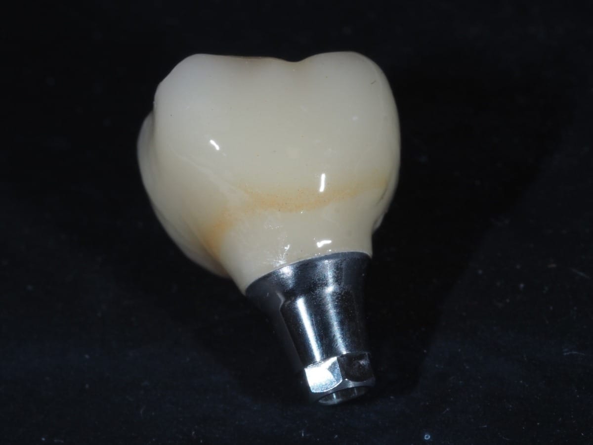 Single Tooth Implants