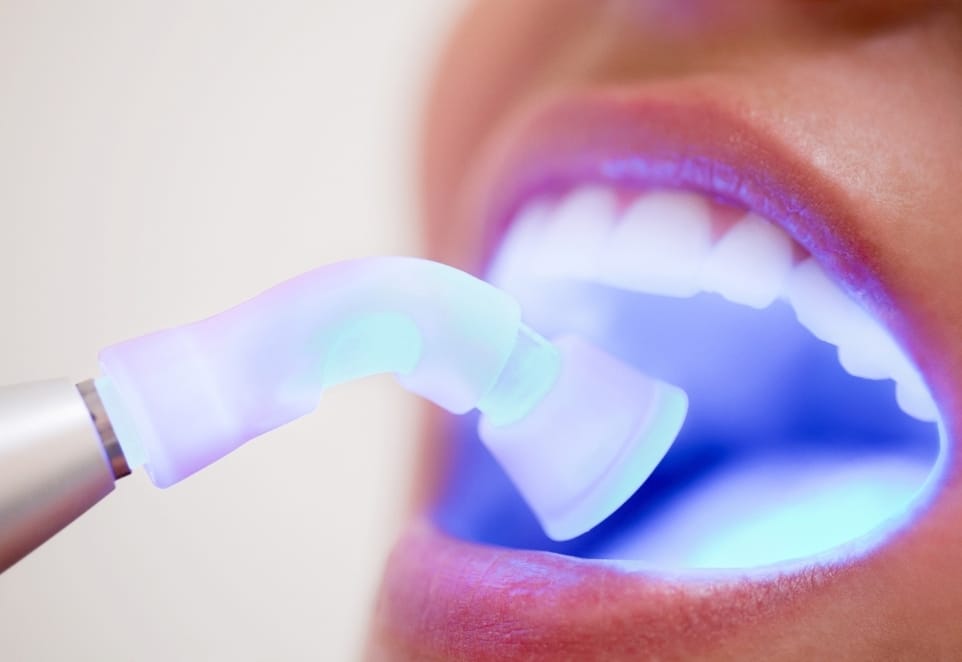 Dental Bonding in Franklin Square NY