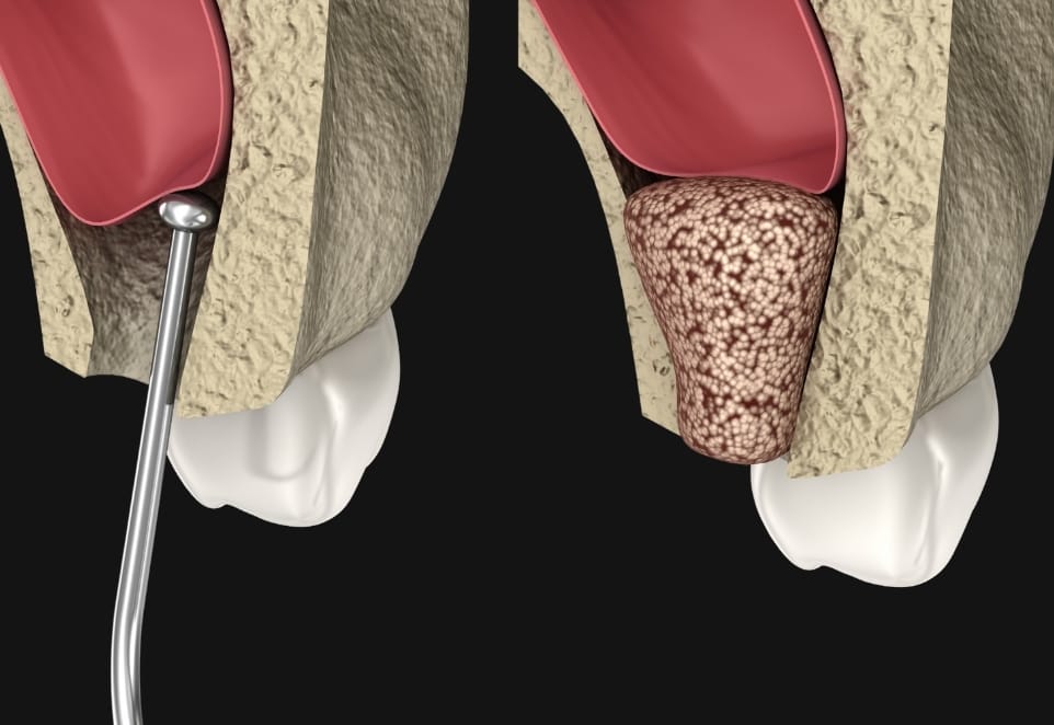 Dental Bone Graft in Franklin Square, NY