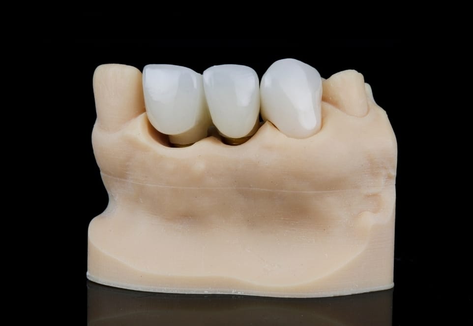 Dental Bridge in Franklin Square NY