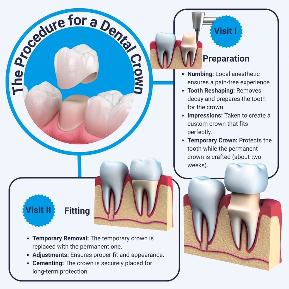 Dental Crown Procedure