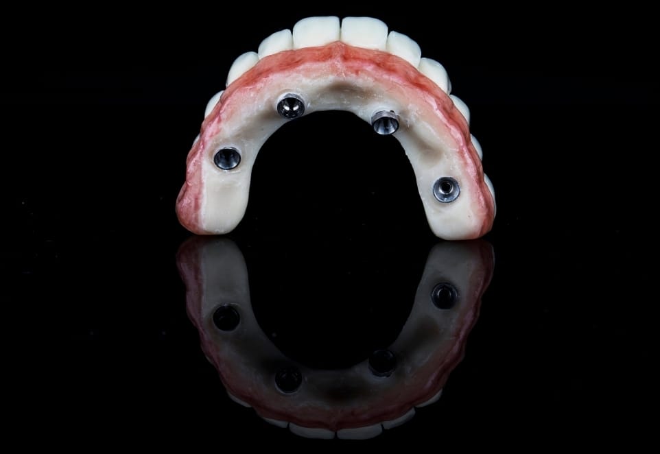 Denture Implants in Franklin Square NY