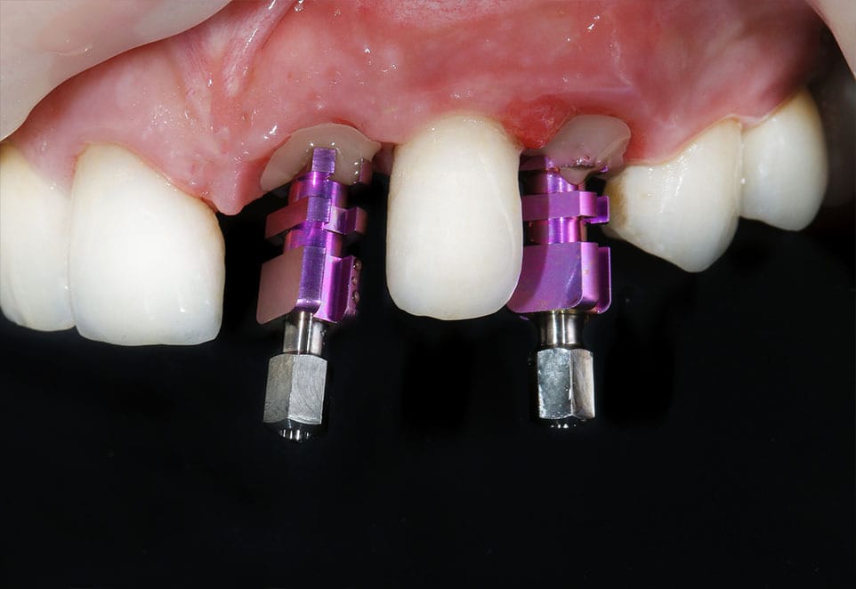 Front Tooth Dental Implants in Franklin Square NY