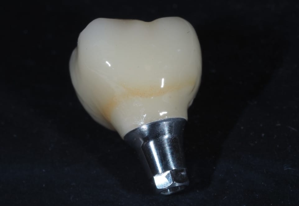 Mini Dental Implants in Franklin Square NY