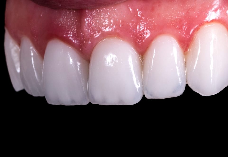Porcelain Veneers Pictures Gallery in Franklin Square NY