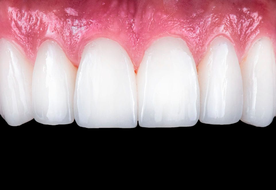 Porcelain Veneers in Franklin Square NY