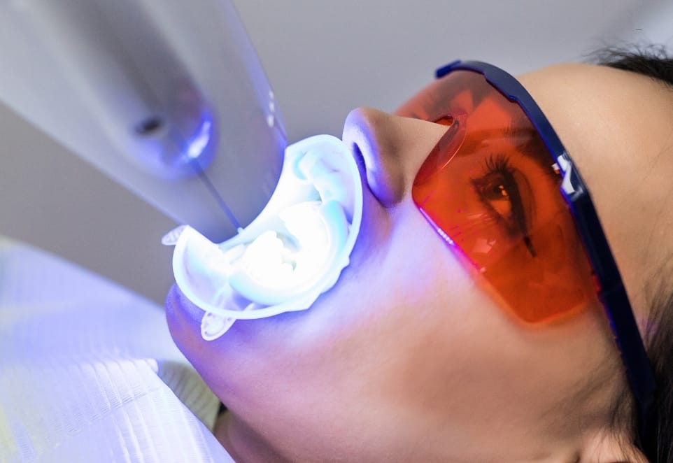 Teeth Whitening Bleaching Pictures Gallery