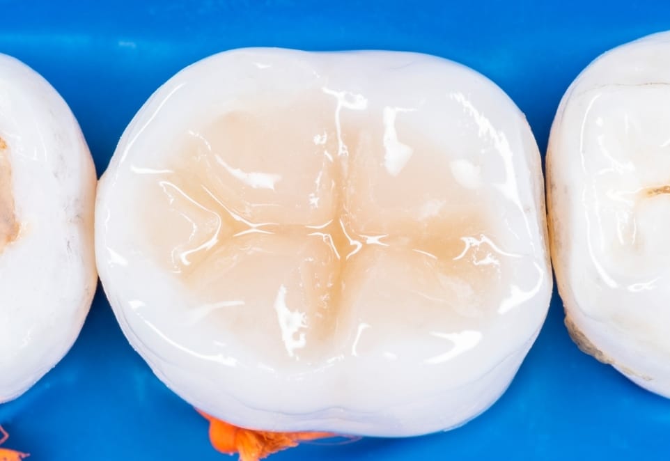 Tooth Colored Fillings in Franklin Square New York