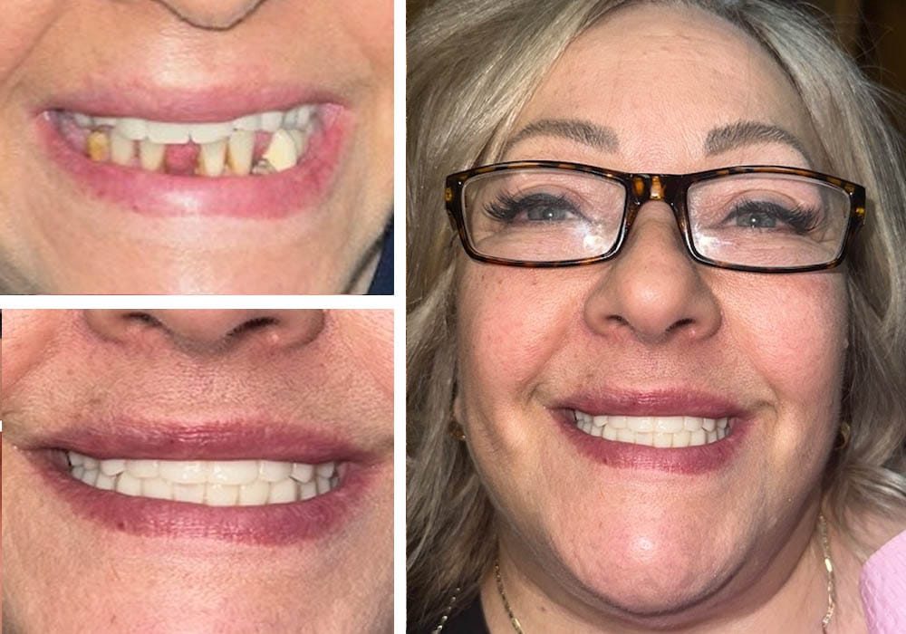 All-on-4 Implants Before and After Results | Case 17