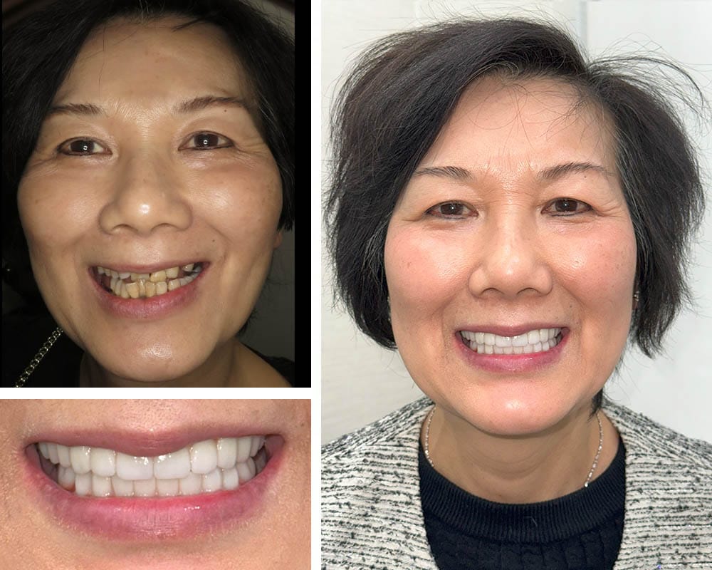 All-on-4 Implants Before and After Results