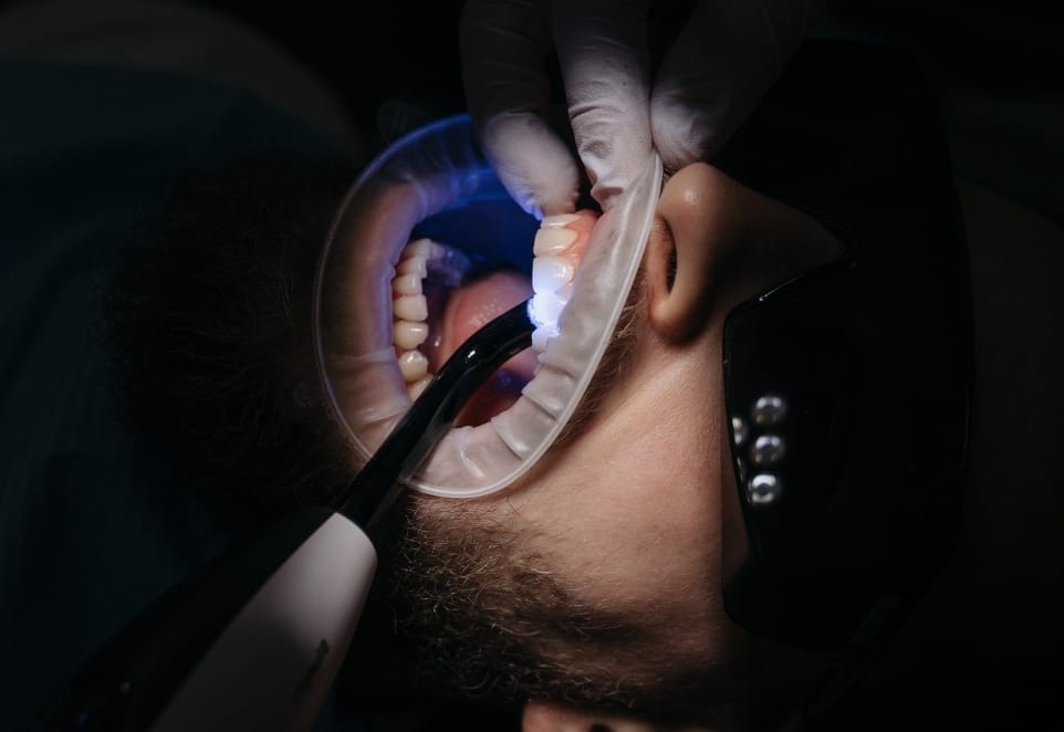 Cavities Treatment