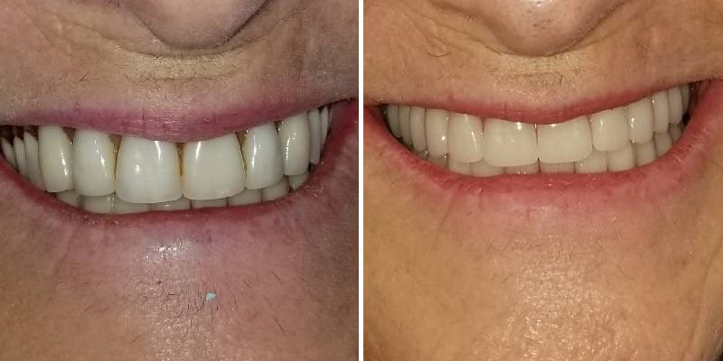 Cosmetic Dentistry Before After Results Case 1