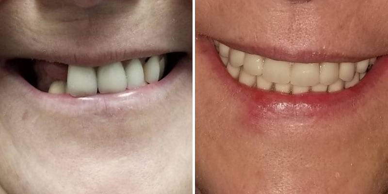 Cosmetic Dentistry Before After Results Case 7