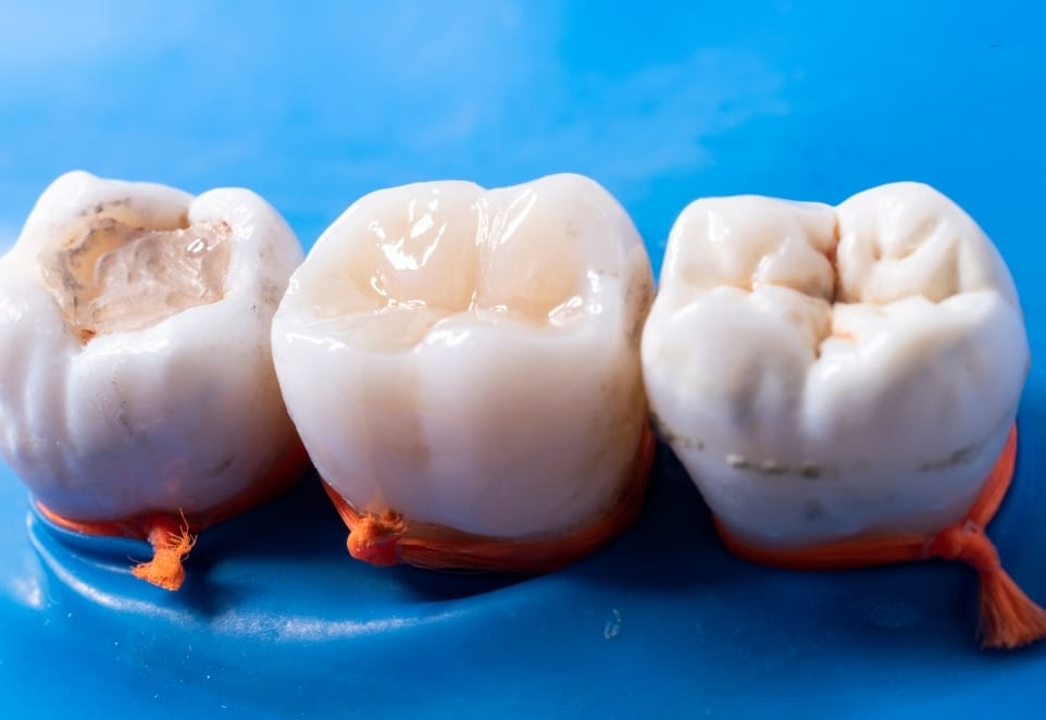 Dental Fillings