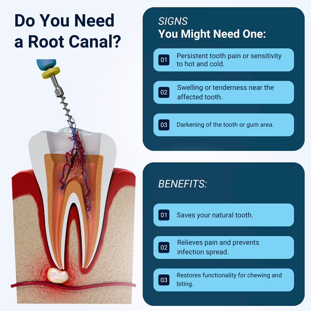 Do You Need a Root Canal?