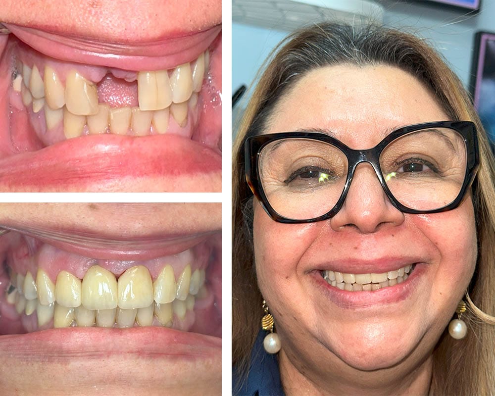 Front Tooth Implants Before and After Pictures (Case 1)