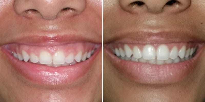 Gum Contouring Before After Results Case 4