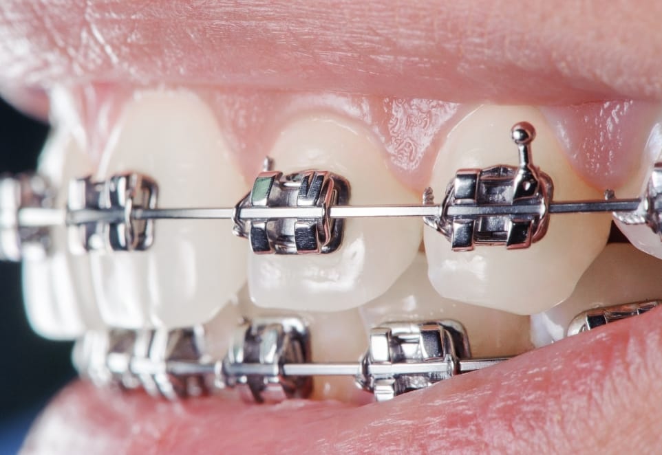 Orthodontic Care
