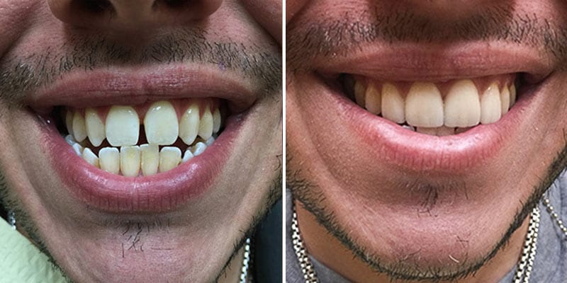 Porcelain Veneers Before After Results Case 10