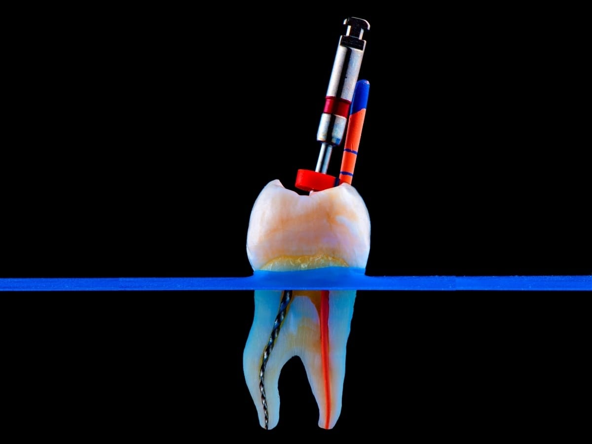 Root Canal