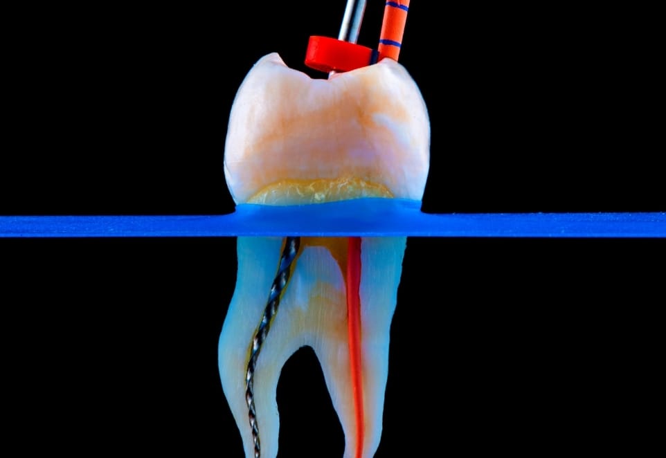 Root Canal Re-Treatment