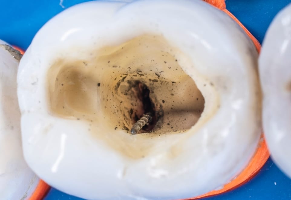 Root Canal Treatment