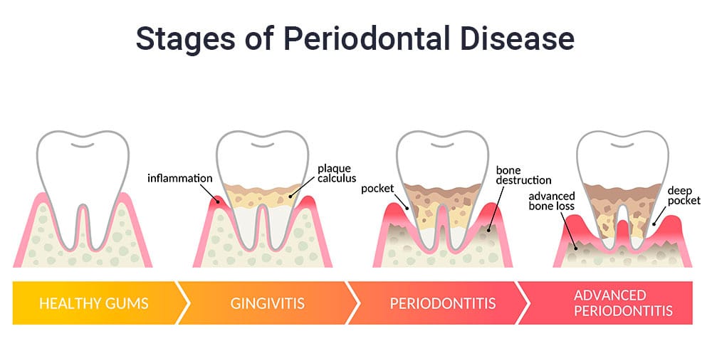 Stages of Periodontal Disease