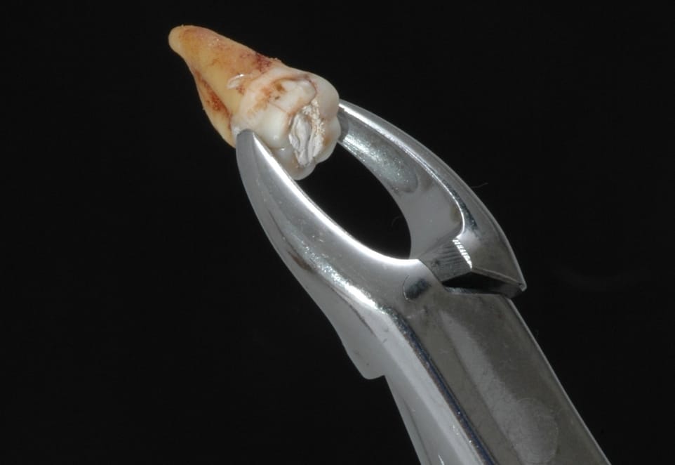 Tooth Extractions