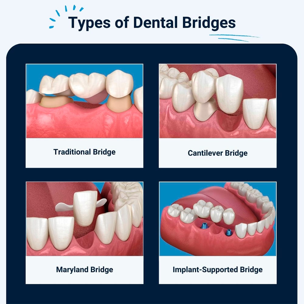 Types of Dental Bridges
