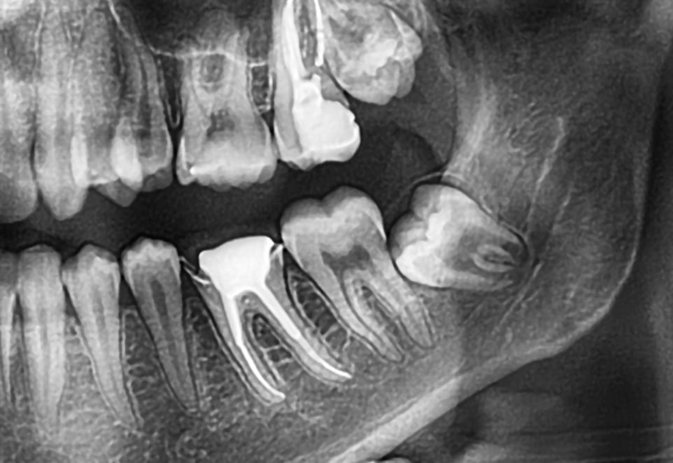 Wisdom Teeth Removal