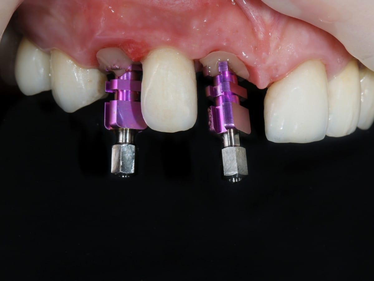 Dental Implants in Franklin Square