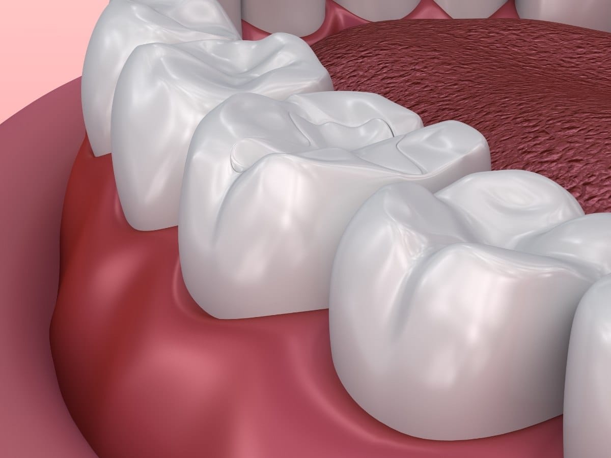 Dental Sealants in Franklin Square