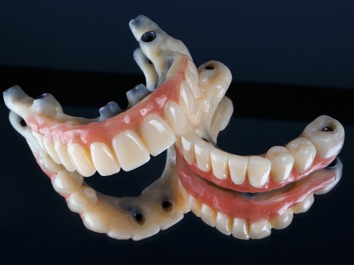 Full Mouth Dental Implants in Franklin Square