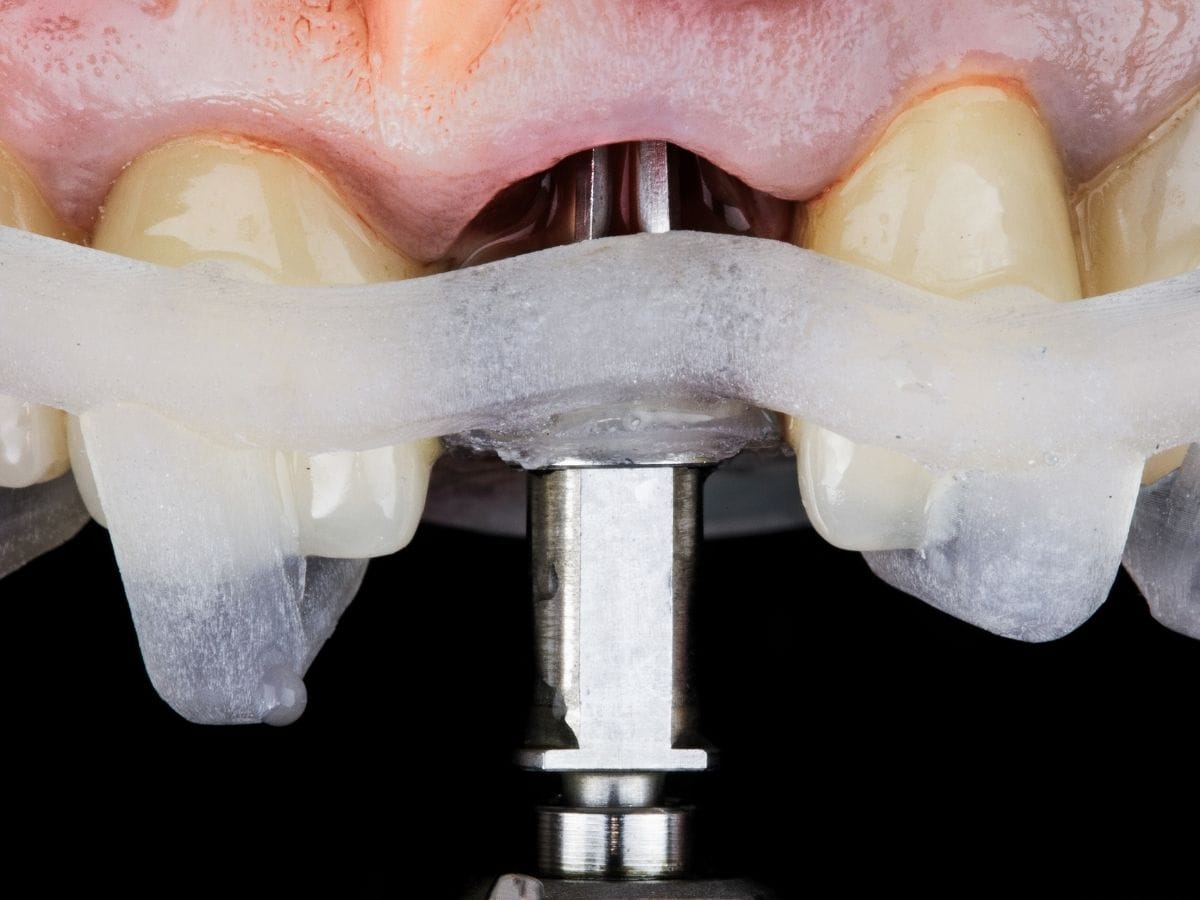 Single Tooth Implants in Franklin Square