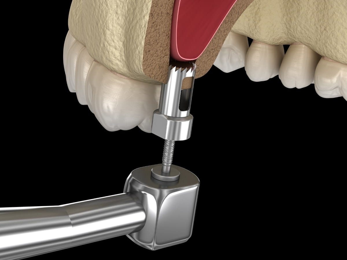 Sinus Lift in Franklin Square
