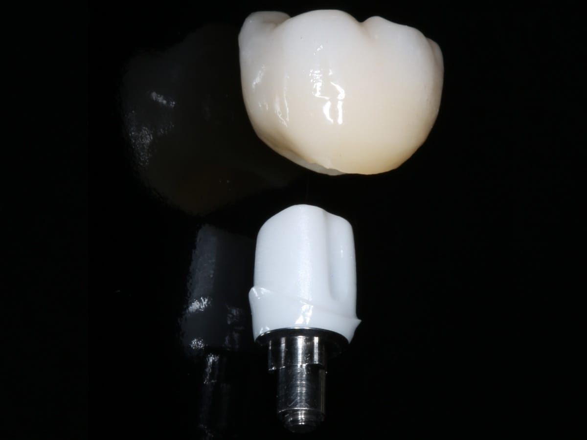 Zirconia Implants in Franklin Square