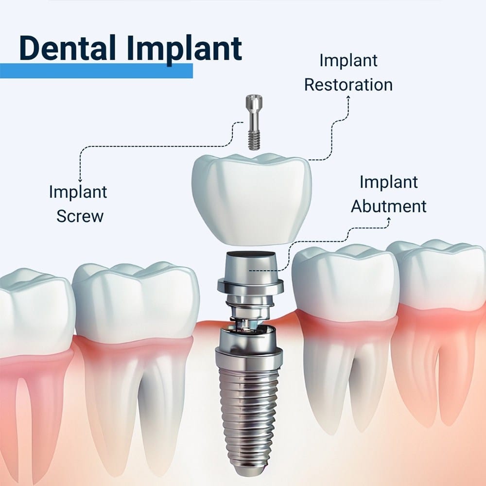 Dental Implant Procedure Duration in Franklin Square NY