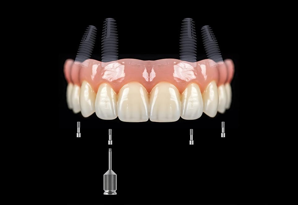 Dental Implants Franklin Square NY