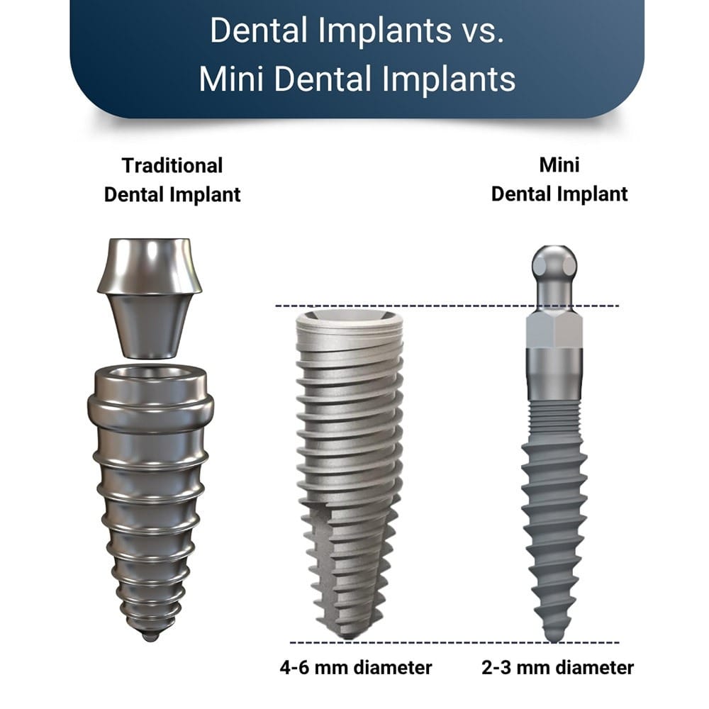 Difference Between Dental Implants and Mini Dental Implants
