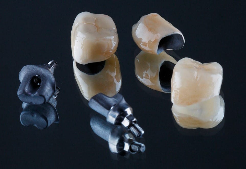 Difference Between Dental Implants and Mini Dental Implants