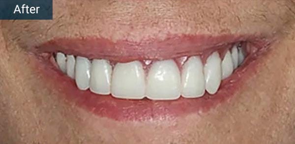 Full Mouth Dental Iimplants After