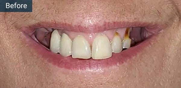Full Mouth Dental Implants Before