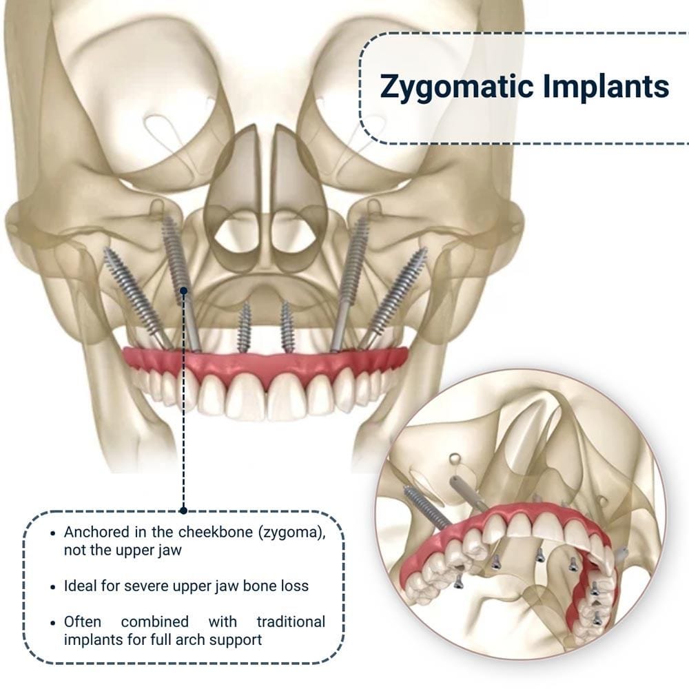 Zygomatic Implants Franklin Square NY