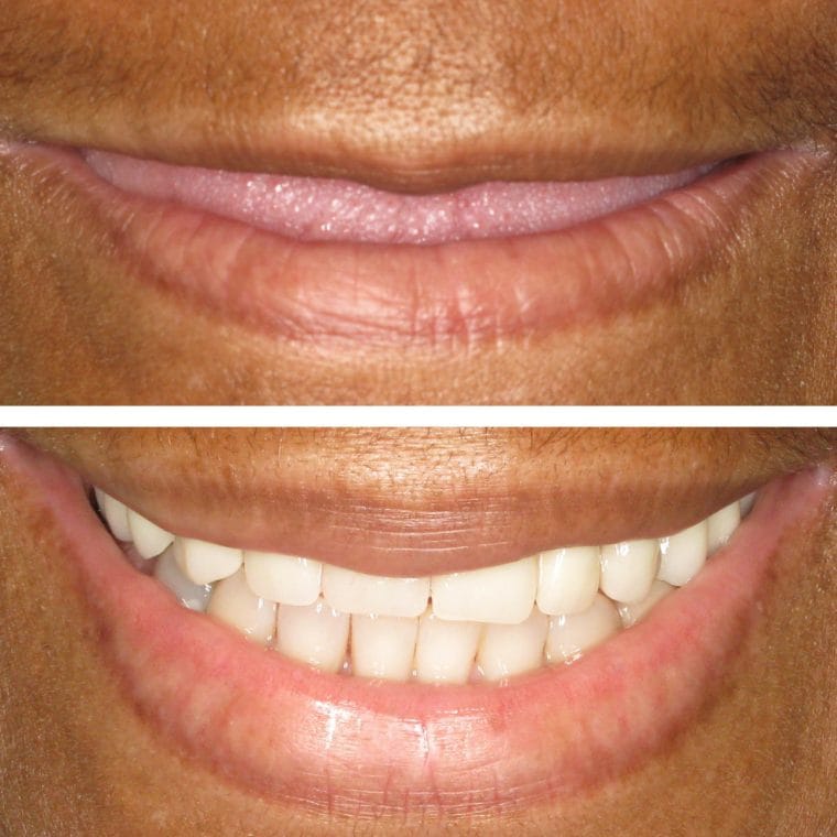All-on-4 Implants Before and After Results | Case 18