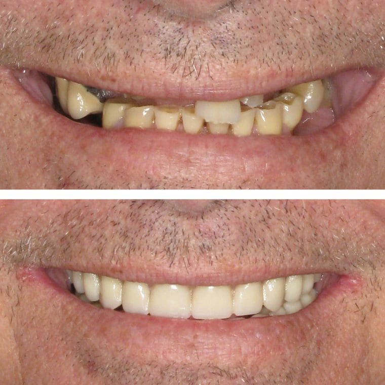 All-on-4 Implants Before and After Results | Case 19