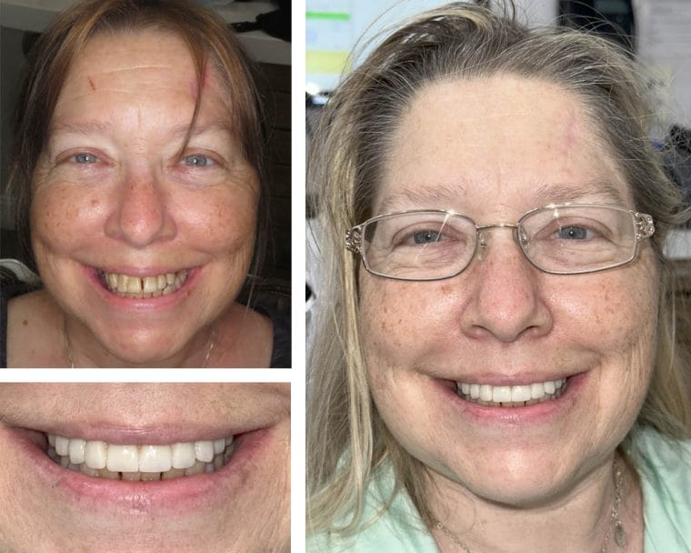 All-on-4 Implants Before and After Results | Case 21