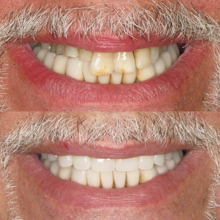 All-on-4 Implants Before and After Results | Case 22