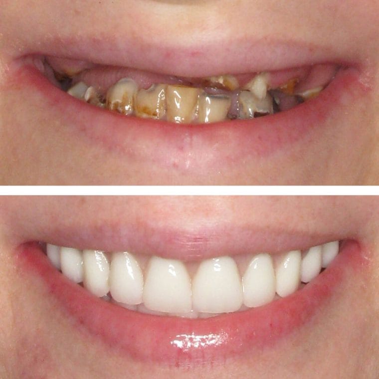 All-on-4 Implants Before and After Results | Case 23