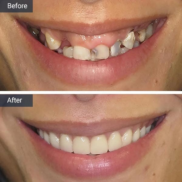 Dental Implants Before After Results