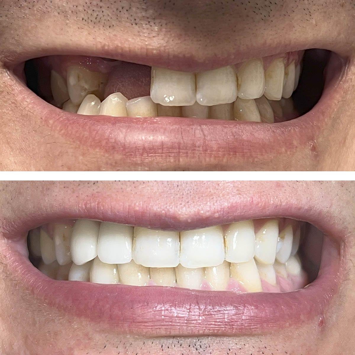 Front Tooth Implants Before and After Pictures (Case 2)